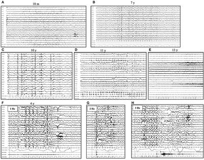 Neurophysiological Findings in Neuronal Ceroid Lipofuscinoses